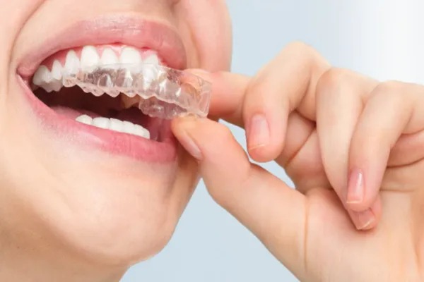 Invisalign