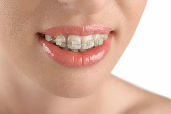 Ceramic Braces