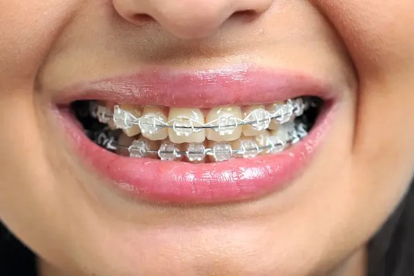 Clear Braces