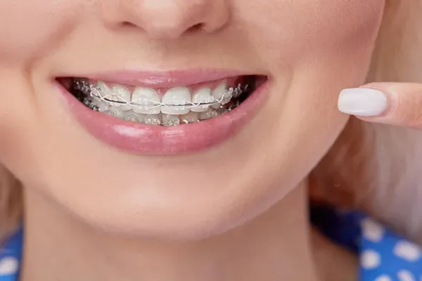 Self-Ligating Braces in Pune