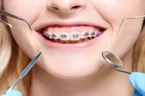 Braces Treatment in Pune