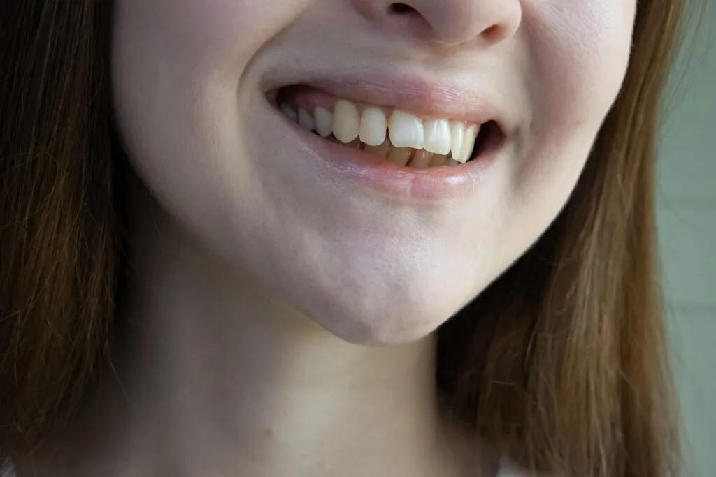 Overbite