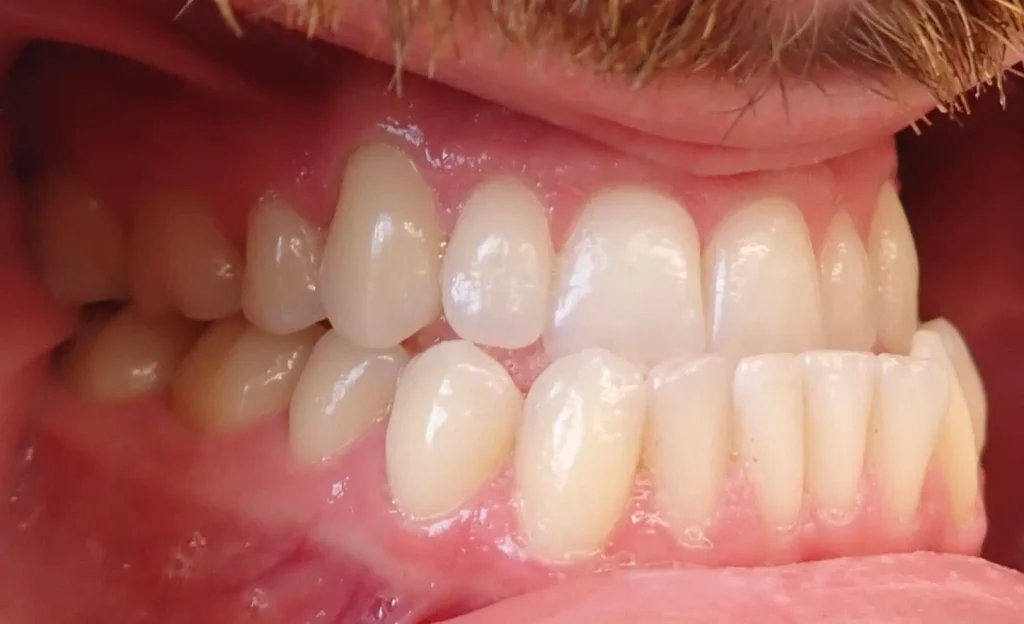 Underbite