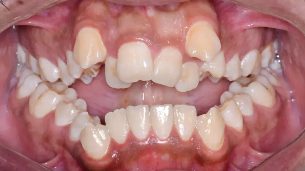 Crowded Teeth
