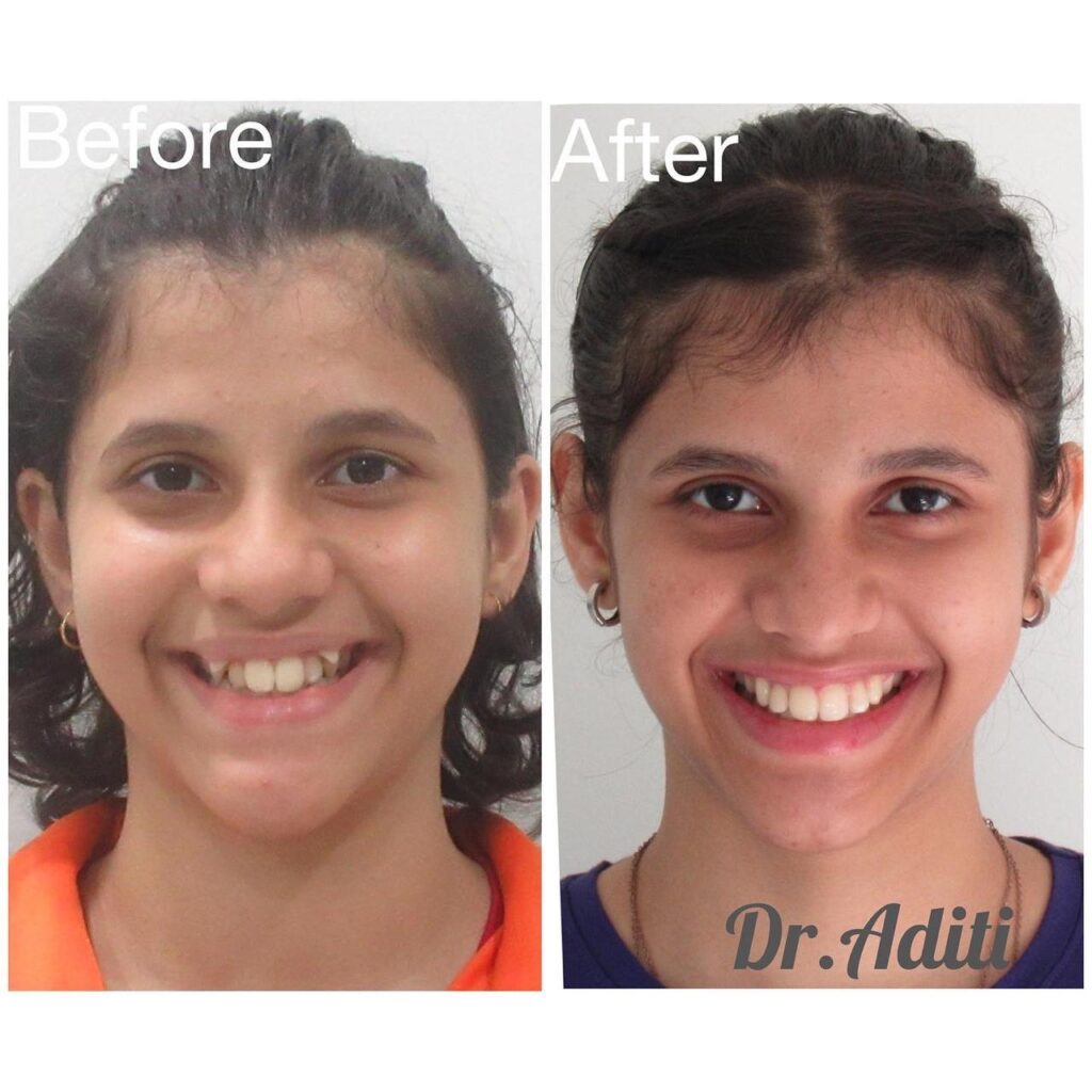 Orthodontist in Pune